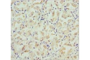 Immunohistochemistry of paraffin-embedded human gastric cancer using ABIN7146127 at dilution of 1:100 (CXCL14 Antikörper  (AA 35-111))