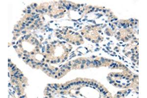 The image on the left is immunohistochemistry of paraffin-embedded Human thyroid cancer tissue using ABIN7192395(SLC16A11 Antibody) at dilution 1/25, on the right is treated with synthetic peptide. (SLC16A11 Antikörper)