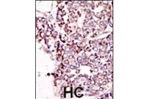 Formalin-fixed and paraffin-embedded human cancer tissue reacted with the primary antibody, which was peroxidase-conjugated to the secondary antibody, followed by DAB staining. (TYRO3 Antikörper  (C-Term))