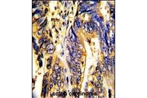 Formalin-fixed and paraffin-embedded human colon carcinoma with AXL Antibody, which was peroxidase-conjugated to the secondary antibody, followed by DAB staining. (AXL Antikörper)