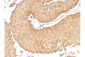 Formalin-fixed, paraffin-embedded human Ovarian Carcinoma stained with Calcineurin A Mouse Monoclonal Antibody (CALNA/2353). (PPP3CA Antikörper)