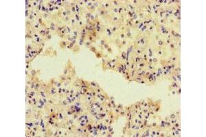 Immunohistochemistry of paraffin-embedded human lung cancer using ABIN7143320 at dilution of 1:100 (ADCY1 Antikörper  (AA 416-610))