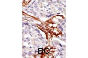 Formalin-fixed and paraffin-embedded human cancer tissue reacted with the primary antibody, which was peroxidase-conjugated to the secondary antibody, followed by AEC staining. (YES1 Antikörper  (N-Term))