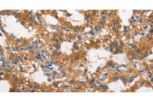 Immunohistochemistry of paraffin-embedded Human thyroid cancer using CLTC Polyclonal Antibody at dilution of 1:60 (Clathrin Heavy Chain (CLTC) Antikörper)
