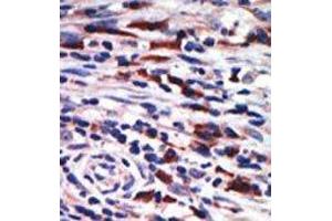 Formalin-fixed and paraffin-embedded human cancer tissue reacted with the primary antibody, which was peroxidase-conjugated to the secondary antibody, followed by AEC staining. (PKC eta Antikörper  (N-Term))