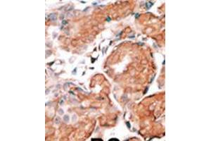 Formalin-fixed and paraffin-embedded human cancer tissue reacted with the primary antibody, which was peroxidase-conjugated to the secondary antibody, followed by DAB staining. (GCAP1 Antikörper  (C-Term))