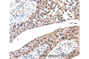 Immunohistochemistry of Human esophagus cancer using GJB2 Polyclonal Antibody at dilution of 1:100