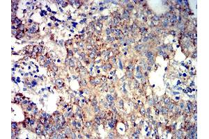 Immunohistochemical analysis of paraffin-embedded stomach cancer tissues using ATG3 mouse mAb with DAB staining. (ATG3 Antikörper  (AA 1-100))