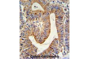 RPL17 Antibody (C-term) IHC analysis in formalin fixed and paraffin embedded colon carcinoma followed by peroxidase conjugation of the secondary antibody and DAB staining. (RPL17 Antikörper  (C-Term))