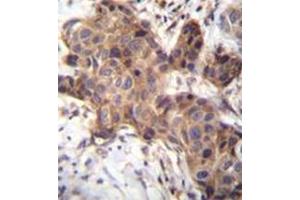Immunohistochemistry analysis in formalin fixed and paraffin embedded human breast carcinoma reacted with GDF9 Antibody (N-term) followed by peroxidase conjugation of the secondary antibody and DAB staining.