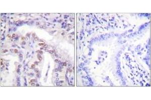 Immunohistochemistry analysis of paraffin-embedded human lung carcinoma, using SENP6 Antibody. (SENP6 Antikörper  (AA 1042-1091))