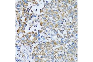 Immunohistochemistry of paraffin-embedded human lung cancer using RARS antibody. (RARS Antikörper)
