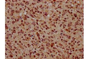 IHC image of ABIN7145737 diluted at 1:500 and staining in paraffin-embedded human glioma performed on a Leica BondTM system. (BSX Antikörper  (AA 1-233))