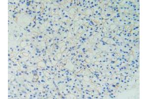 IHC-P analysis of Human Kidney Cancer Tissue, with DAB staining. (PODXL Antikörper  (AA 220-431))