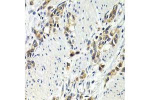Immunohistochemistry of paraffin-embedded human stomach cancer using WNT3A antibody at dilution of 1:200 (400x lens). (WNT3A Antikörper)