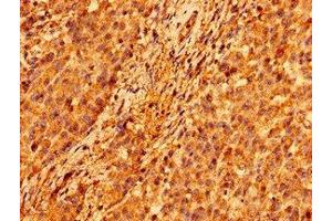 Immunohistochemistry of paraffin-embedded human colon cancer using ABIN7146306 at dilution of 1:100 (ORAI1 Antikörper  (AA 1-87))