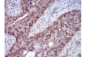 Immunohistochemical analysis of paraffin-embedded cervical cancer tissues using ERBB4 mouse mAb with DAB staining. (ERBB4 Antikörper  (AA 1159-1308))