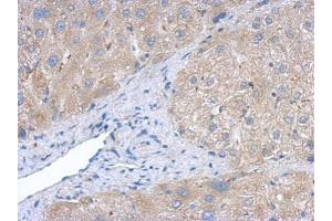 IHC-P Image Immunohistochemical analysis of paraffin-embedded human hepatoma, using Creatine kinase (brain) antibody, antibody at 1:500 dilution. (CKB Antikörper)