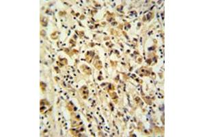 Formalin fixed and paraffin embedded human breast carcinoma reacted with DDX49 Antibody (C-term) followed by peroxidase conjugation of the secondary antibody and DAB staining. (DDX49 Antikörper  (C-Term))