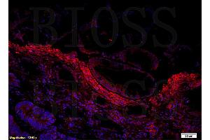 Formalin-fixed and paraffin embedded human colon cancer labeled with Anti Amphiregulin Polyclonal Antibody, Unconjugated followed by conjugation to the secondary antibody and DAPI staining (Amphiregulin Antikörper  (AA 185-252))