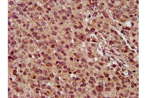 IHC image of ABIN7159657 diluted at 1:300 and staining in paraffin-embedded human glioma performed on a Leica BondTM system. (MMADHC Antikörper  (AA 26-142))