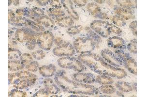 ABIN6261450 and ABIN6266845 at 1/100 staining human renal cell carcinoma by IHC-P.