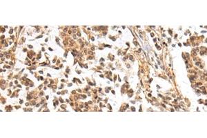 Immunohistochemistry of paraffin-embedded Human breast cancer tissue using NHLRC2 Polyclonal Antibody at dilution of 1:40(x200) (NHLRC2 Antikörper)