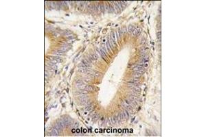 Formalin-fixed and paraffin-embedded human colon carcinoma tissue reacted with AKR1B1 antibody (Center) (ABIN389206 and ABIN2839364) , which was peroxidase-conjugated to the secondary antibody, followed by DAB staining. (AKR1B1 Antikörper  (AA 102-135))