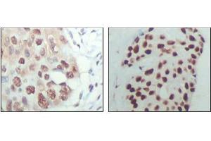 Immunohistochemical analysis of paraffin-embedded human esophagus cancer (left) and breast carcinoma tissue (right), showing nuclear localization with DAB staining using HDAC3 antibody. (HDAC3 Antikörper  (AA 224-428))