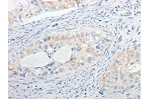 The image on the left is immunohistochemistry of paraffin-embedded Human cervical cancer tissue using ABIN7130256(MPZ Antibody) at dilution 1/15, on the right is treated with fusion protein. (MPZ Antikörper)