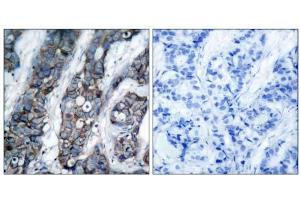 Immunohistochemical analysis of paraffin-embedded human breast carcinoma tissue using HER2 (phospho-Tyr1248) antibody (E011079). (ErbB2/Her2 Antikörper  (pTyr1248))