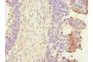 Immunohistochemistry of paraffin-embedded human ovarian cancer using ABIN7167394 at dilution of 1:100 (RALB Antikörper  (AA 1-206))