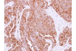 IHC-P Image Immunohistochemical analysis of paraffin-embedded human adenocarcinoma, using HPRT, antibody at 1:500 dilution. (HPRT1 Antikörper)