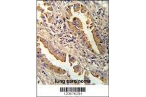 Formalin-fixed and paraffin-embedded human lung carcinoma reacated with IL8 antibody which was peroxidase-conjugated to the secondary antibody, followed by DAB staining. (IL-8 Antikörper  (C-Term))