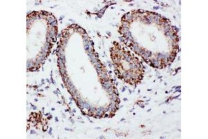 IHC-P: MTCO1 antibody testing of human breast cancer tissue (COX1 Antikörper  (C-Term))