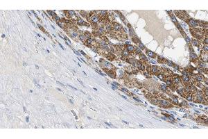 ABIN6269219 at 1/100 staining Human liver cancer tissue by IHC-P. (Cadherin 5 Antikörper  (C-Term))