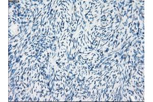 Immunohistochemical staining of paraffin-embedded Adenocarcinoma of breast tissue using anti-FOSL1 mouse monoclonal antibody. (FOSL1 Antikörper)
