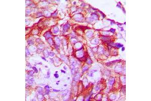 Immunohistochemical analysis of RET (pY1062) staining in human breast cancer formalin fixed paraffin embedded tissue section. (Ret Proto-Oncogene Antikörper  (C-Term, pTyr1062))