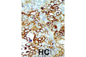 Formalin-fixed and paraffin-embedded human hepatocellular carcinoma tissue reacted with MAP4K2 polyclonal antibody  , which was peroxidase-conjugated to the secondary antibody, followed by AEC staining . (MAP4K2 Antikörper  (Internal Region))