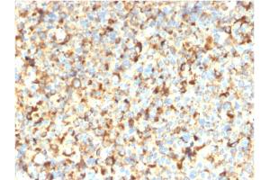 Formalin-fixed, paraffin-embedded human Melanoma stained with CD63-Monospecific Recombinant Mouse Monoclonal Antibody (rMX-49. (Rekombinanter CD63 Antikörper)