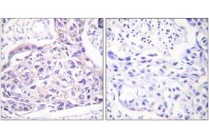 Immunohistochemistry analysis of paraffin-embedded human breast carcinoma, using IRS-1 (Phospho-Ser323) Antibody. (IRS1 Antikörper  (pSer323))