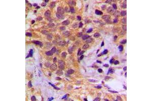 Immunohistochemical analysis of HSP90 beta (pS254) staining in human breast cancer formalin fixed paraffin embedded tissue section. (HSP90AB1 Antikörper  (pSer254))