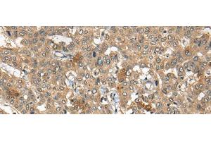 Immunohistochemistry of paraffin-embedded Human liver cancer tissue using ARCN1 Polyclonal Antibody at dilution of 1:50(x200)