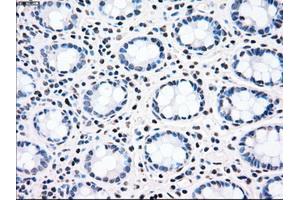 Immunohistochemical staining of paraffin-embedded Adenocarcinoma of ovary tissue using anti-CHEK2mouse monoclonal antibody. (CHEK2 Antikörper)