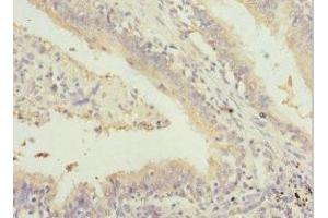 Immunohistochemistry of paraffin-embedded human lung cancer using ABIN7153505 at dilution of 1:100 (GABRR1 Antikörper  (AA 365-465))