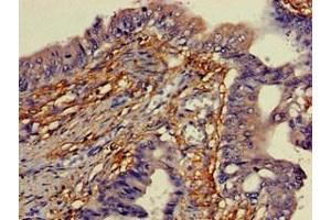 Immunohistochemistry of paraffin-embedded human colon cancer using ABIN7166338 at dilution of 1:100 (YIPF3 Antikörper  (AA 2-148))