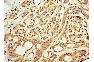 Immunohistochemistry of paraffin-embedded human breast cancer using ABIN7143228 at dilution of 1:100 (ACSM3 Antikörper  (AA 387-586))