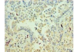 Immunohistochemistry of paraffin-embedded human lung cancer using ABIN7156537 at dilution of 1:100 (ICAM2 Antikörper  (AA 25-223))