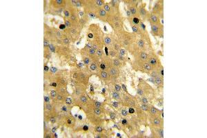 Formalin-fixed and paraffin-embedded human hepatocarcinoma reacted with SCP2 Antibody , which was peroxidase-conjugated to the secondary antibody, followed by DAB staining. (SCP2 Antikörper  (AA 358-385))