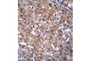 Immunohistochemistry analysis in formalin fixed and paraffin embedded human liver tissue reacted with PLEKHA4 Antibody (N-term) followed which was peroxidase conjugated to the secondary antibody and followed by DAB staining. (PLEKHA4 Antikörper  (N-Term))